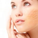 facial anti acne en guadalajara