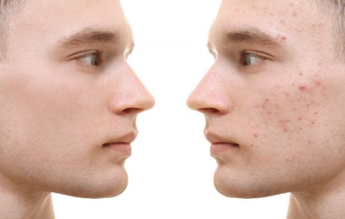 como quitar el acne de la cara en guadalajara