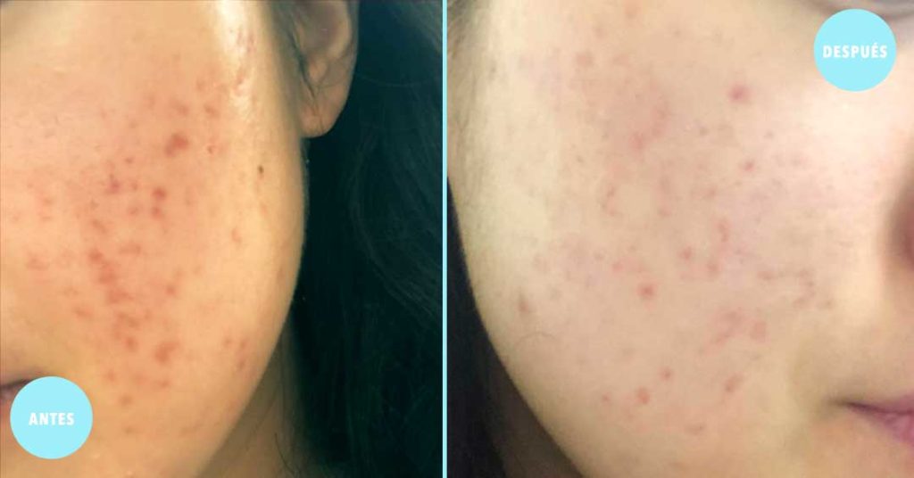 faciales anti acne en guadalajara